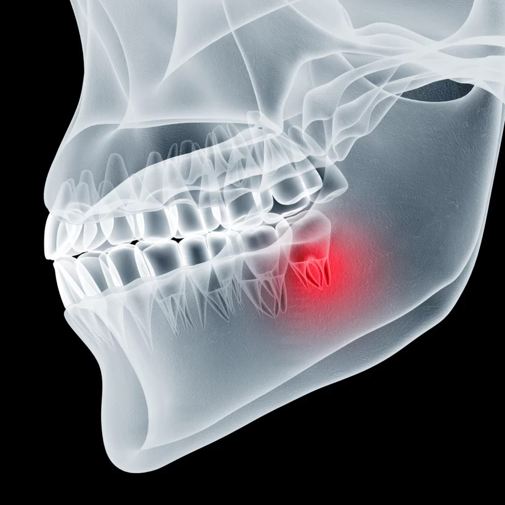 wisdom teeth removal in Duluth, GA