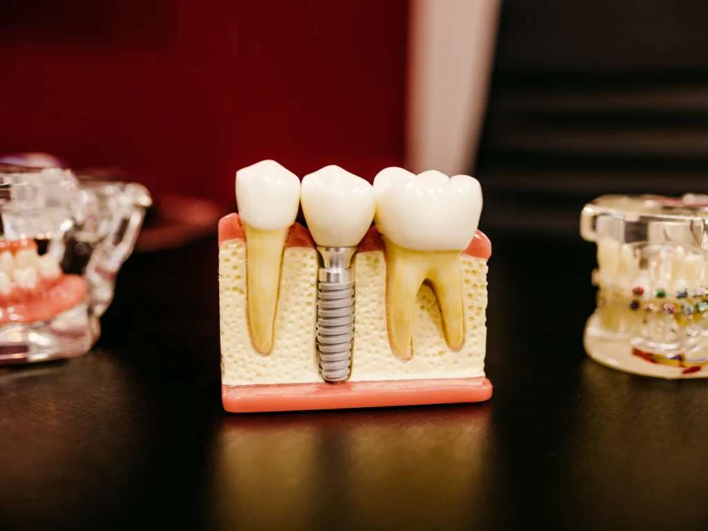 model of a single tooth dental implant | cost of dental implants in Duluth, GA