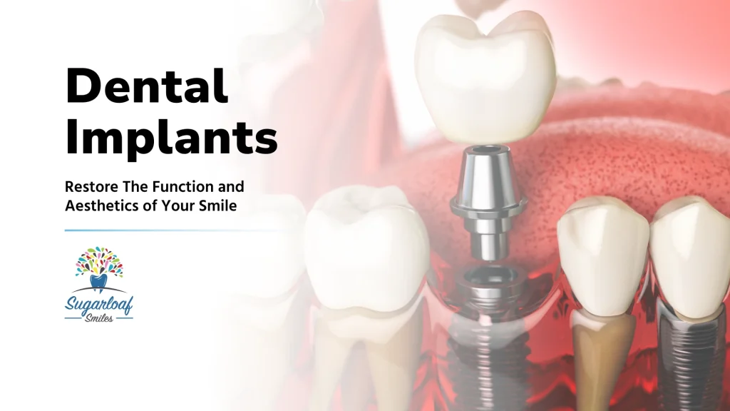 Restore failing or missing teeth with dental implants in Duluth, GA at Sugarloaf Smiles