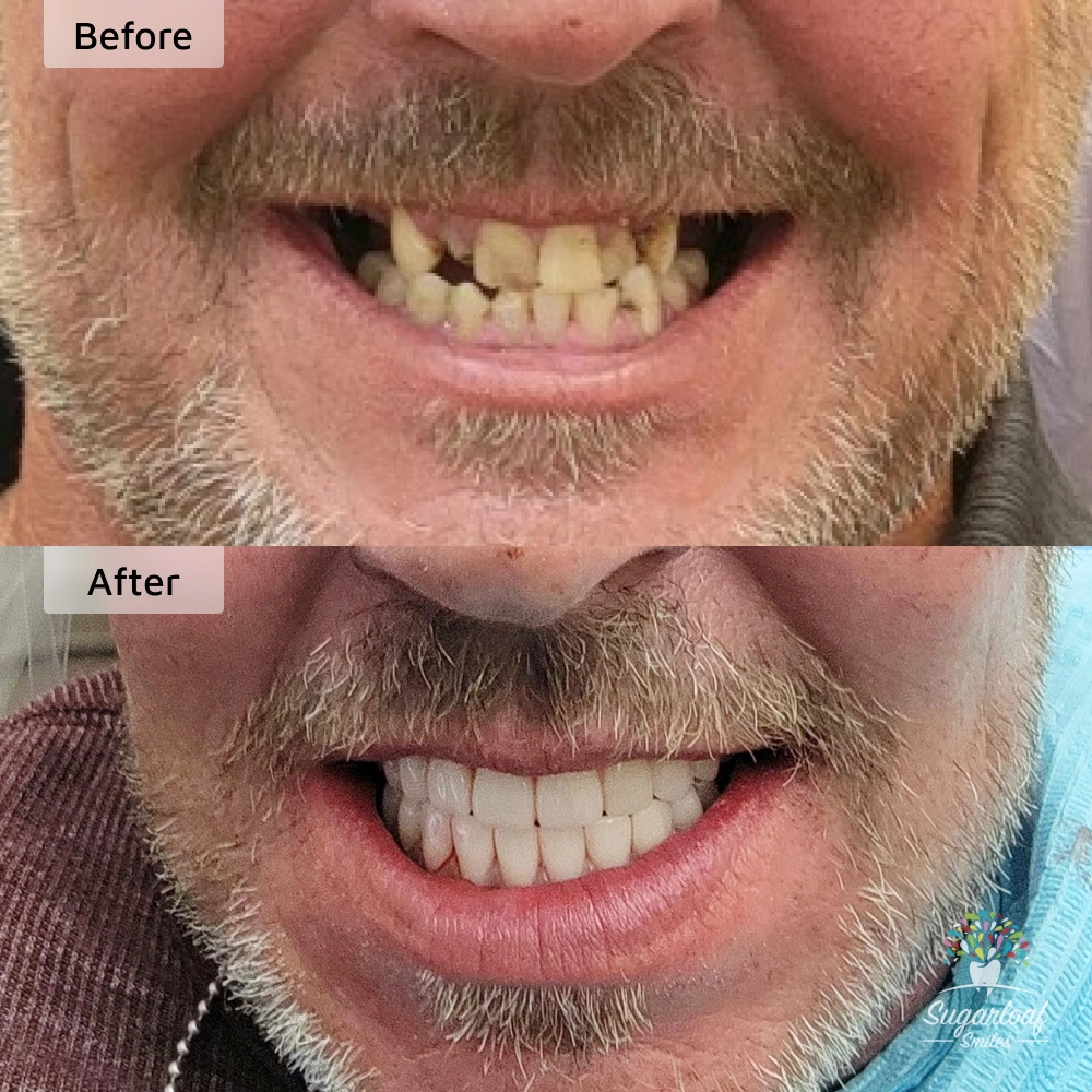 Before and after dental implants in Duluth, GA at Sugarloaf Smiles