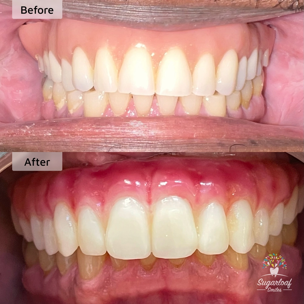 Before and after dental implants in Duluth, GA at Sugarloaf Smiles