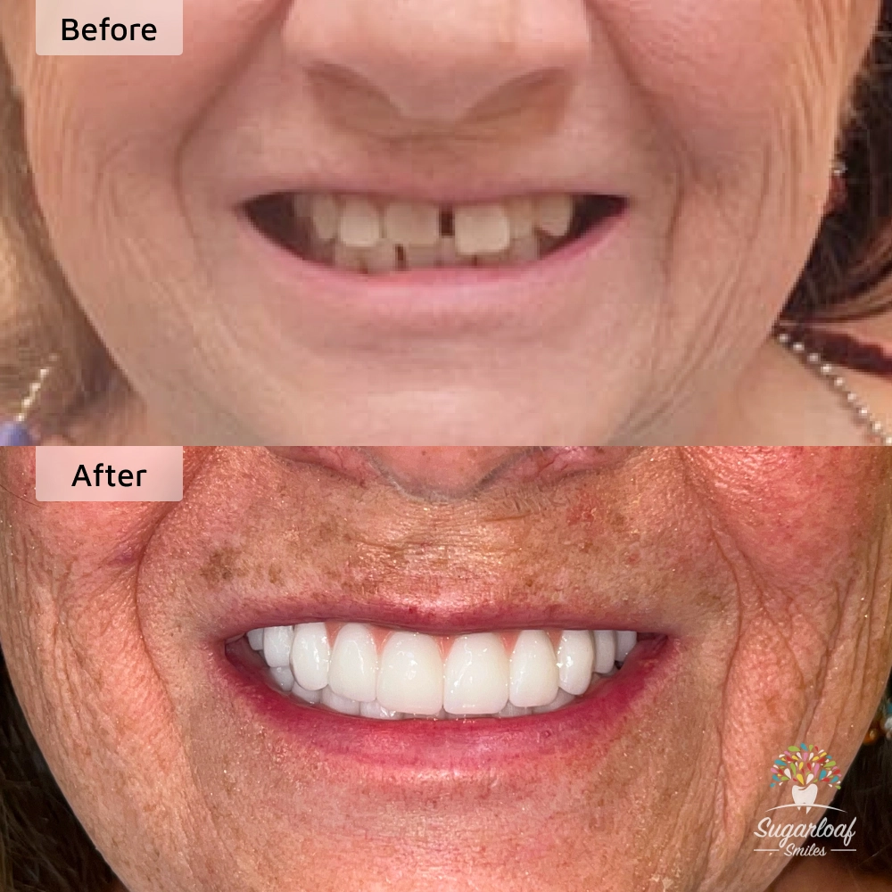 Before and after dental implants in Duluth, GA at Sugarloaf Smiles