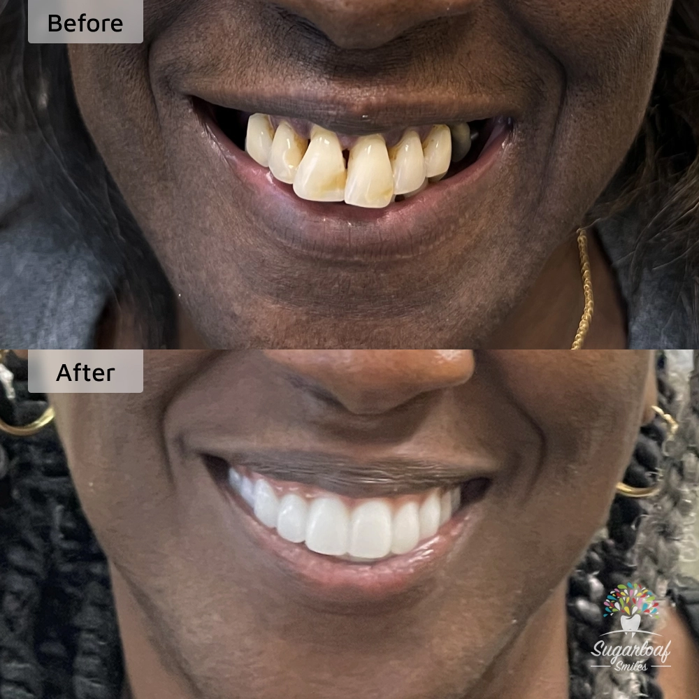Before and after dental implants in Duluth, GA at Sugarloaf Smiles