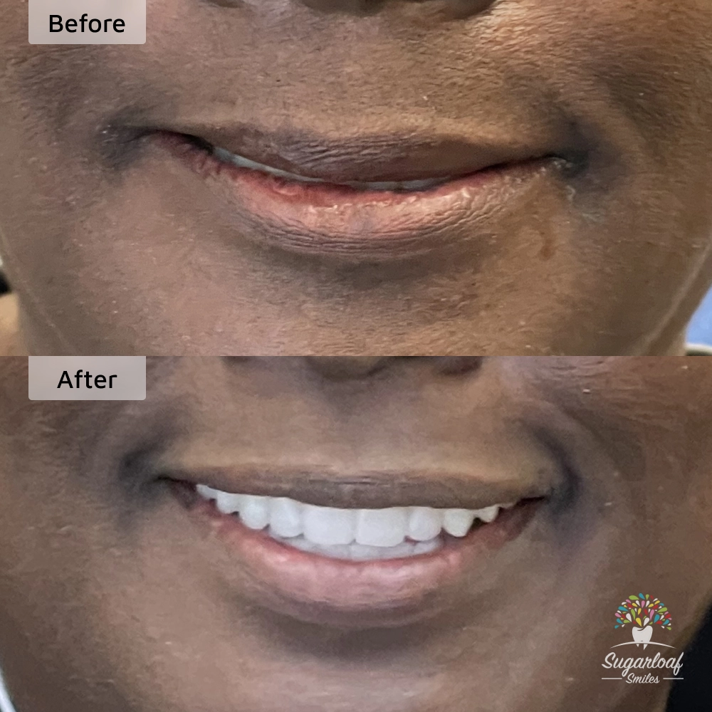 Before and after dental implants in Duluth, GA at Sugarloaf Smiles