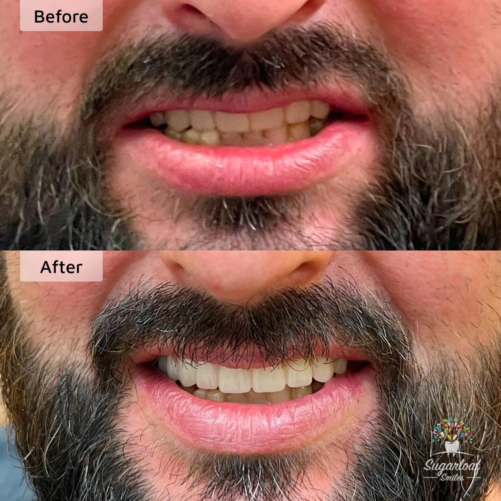 Before and after dental implants in Duluth, GA at Sugarloaf Smiles
