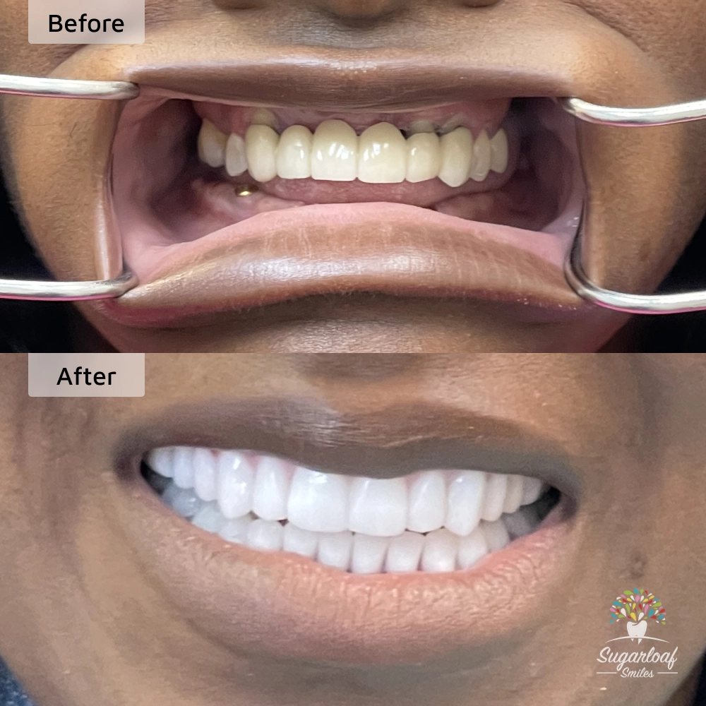 Before and after dental implants in Duluth, GA at Sugarloaf Smiles