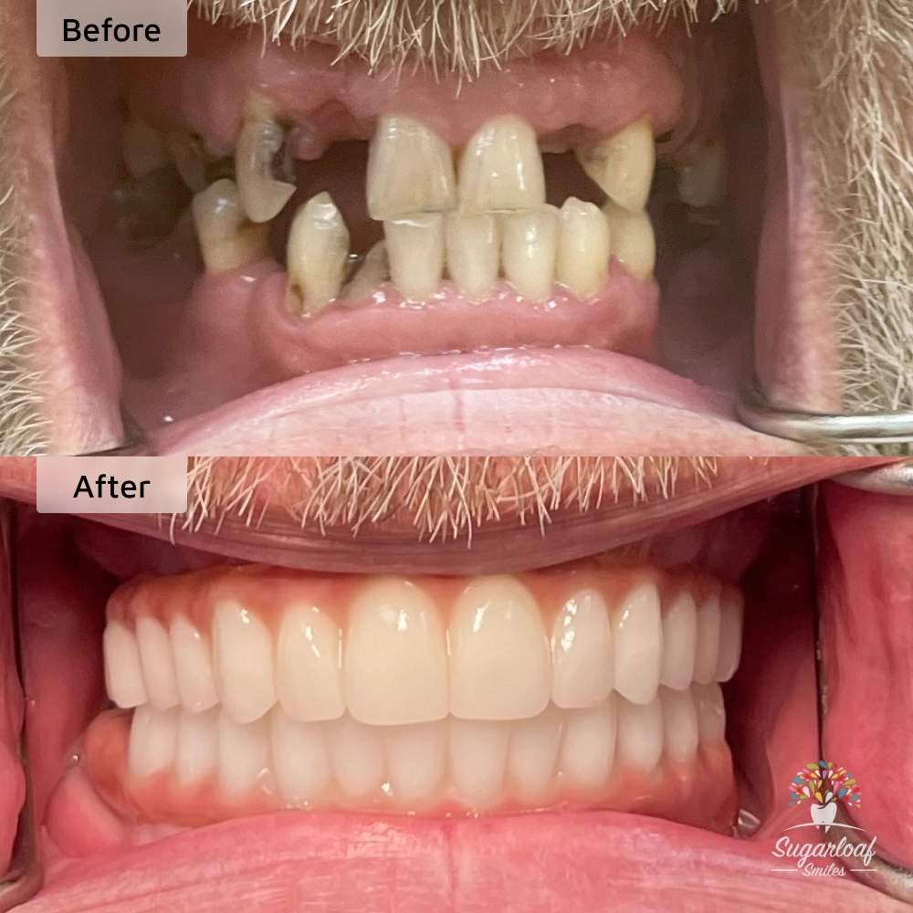 Before and after dental implants in Duluth, GA at Sugarloaf Smiles